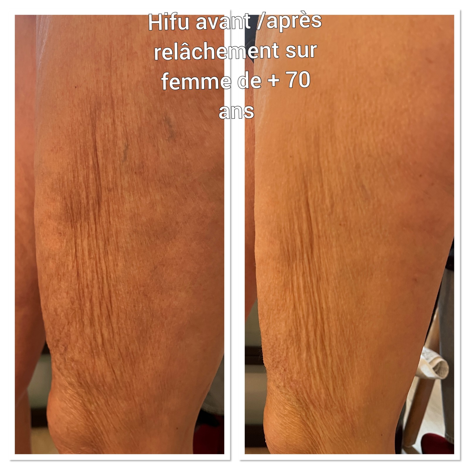 HIFU technologie non invasive et très efficace pour le relâchement des bras/ cuisses après 50 ans à l'institut de beauté à Strasbourg proche Geispolsheim