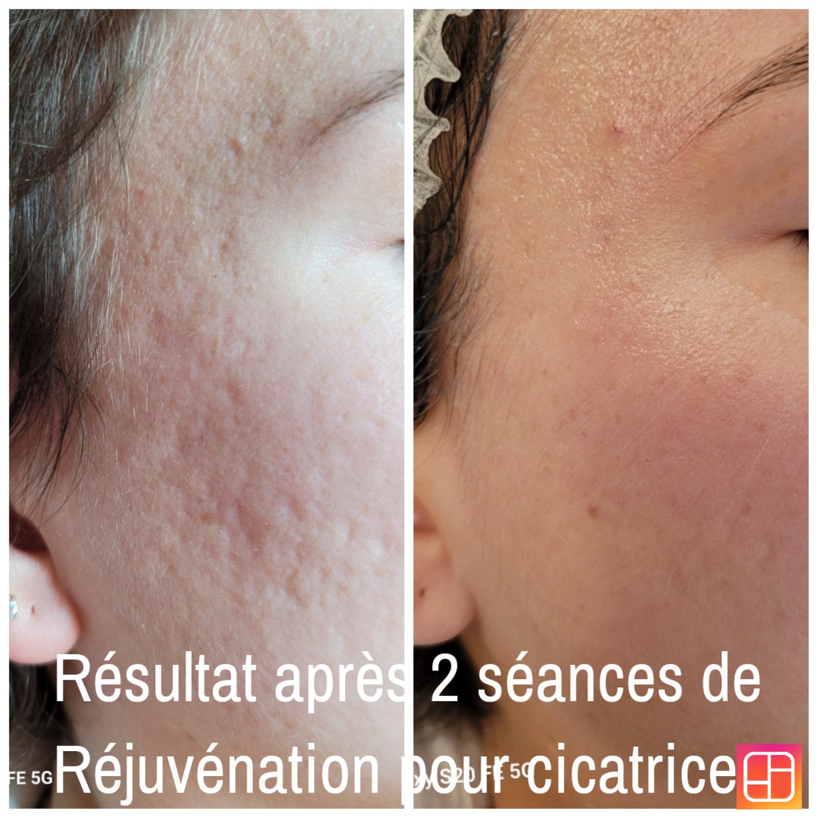 Esthéticienne pour un soin anti-cellulite alternatif à la chirurgie esthétique Vers Obernai