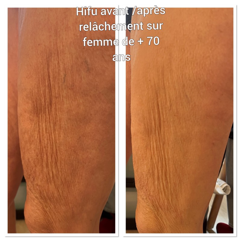 HIFU technologie non invasive et très efficace pour le relâchement des bras/ cuisses après 50 ans à l'institut de beauté à Strasbourg proche Geispolsheim
