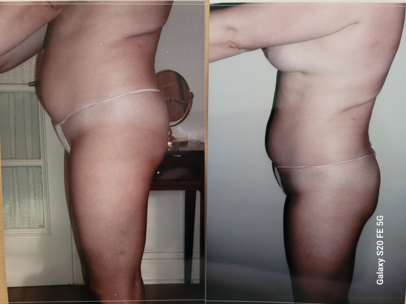 Soin amincissant anticellulite chromoenergy pour femme en ménopause à Strasbourg