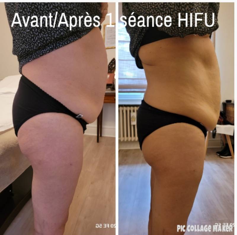 HIFU POUR LMAIGRIR DU VENTRE A L'INSTITUT ANNE WALTERA STRASBOURG