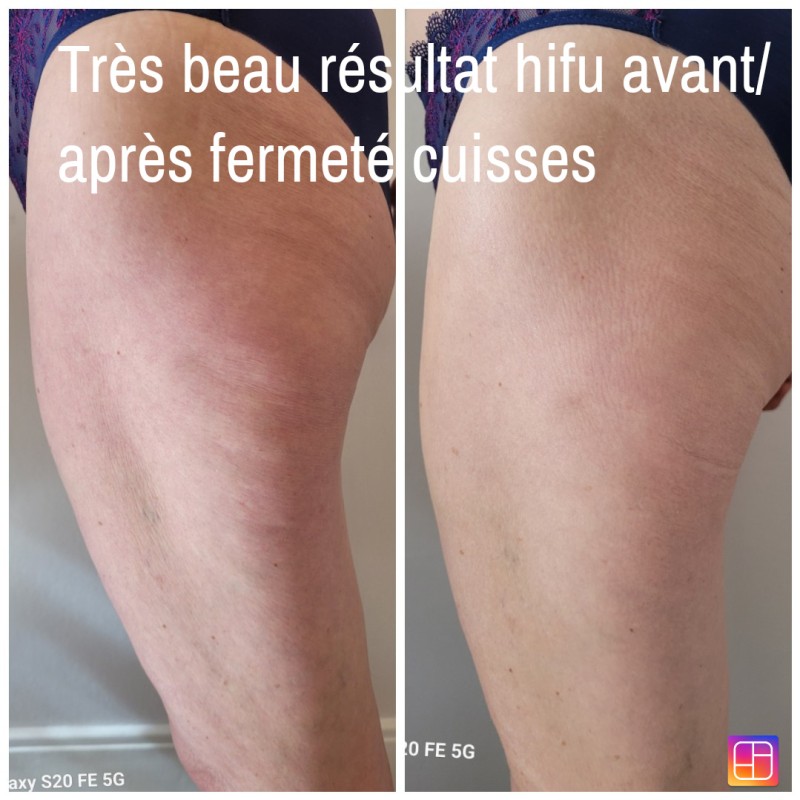 institut de beauté pour faire un soin hifu pour maigrir des cuisses à Strasbourg