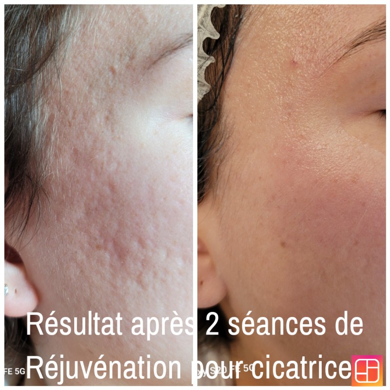 Le soin RÉJUVÉNATION avec notre appareil Light Method  nous donne d excellents résultats sur les cicatrices d acné à l' institut Anne Walter à Strasbourg 