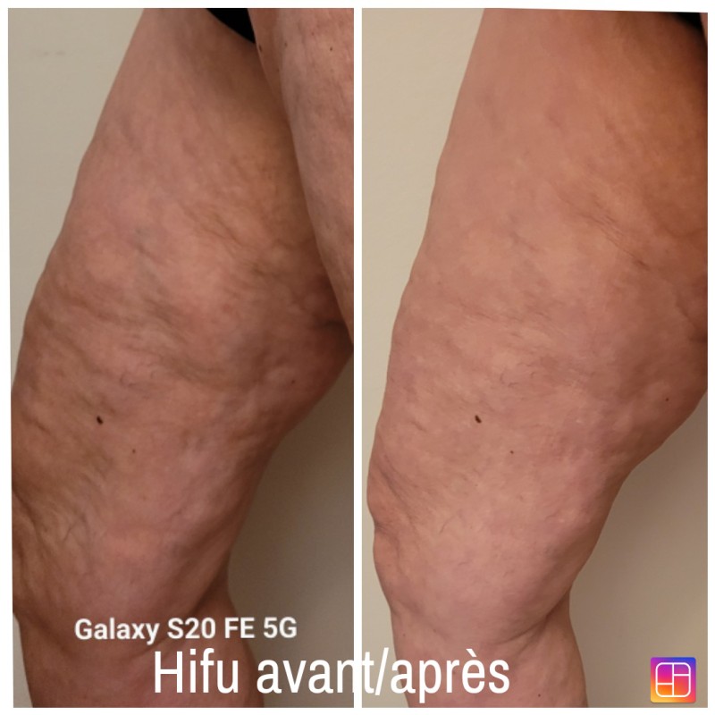 institut de beauté pour faire un soin hifu pour maigrir des cuisses à Strasbourg