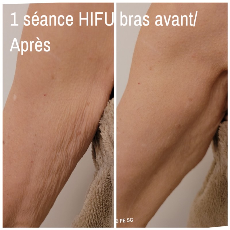 HIFU le meilleur des soins pour lifter et tonifier les bras en institut spécialisé à Strasbourg