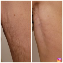 Notre zone d'activité pour ce service Centre esthétique pour une épilation définitive à la lumière pulsée